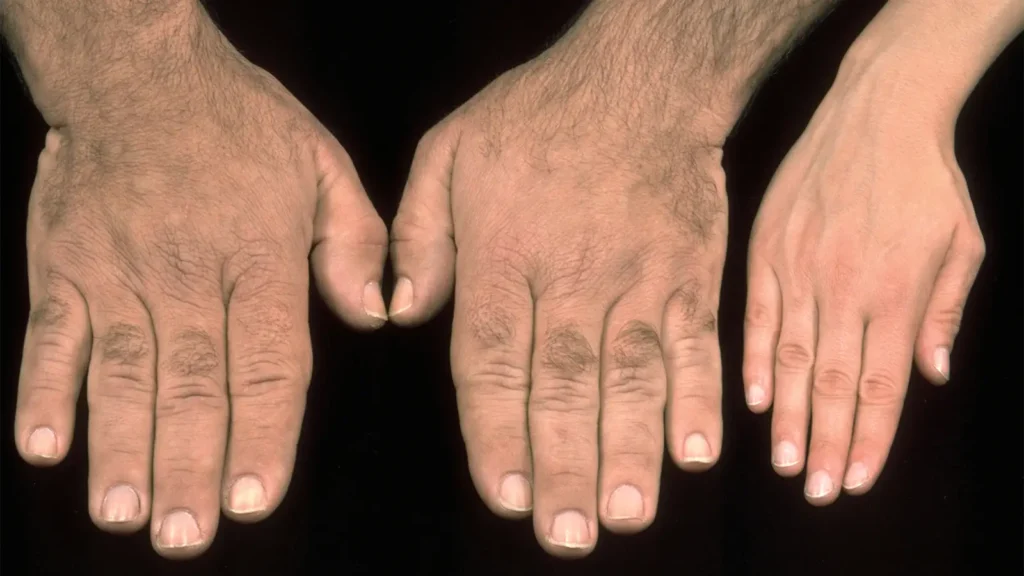 Acromegaly